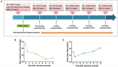 Case Report: Miles Surgery Ameliorates High Blood Pressure in a Rectal Carcinoma Patient With Essential Hypertension